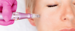 microneedling benefits