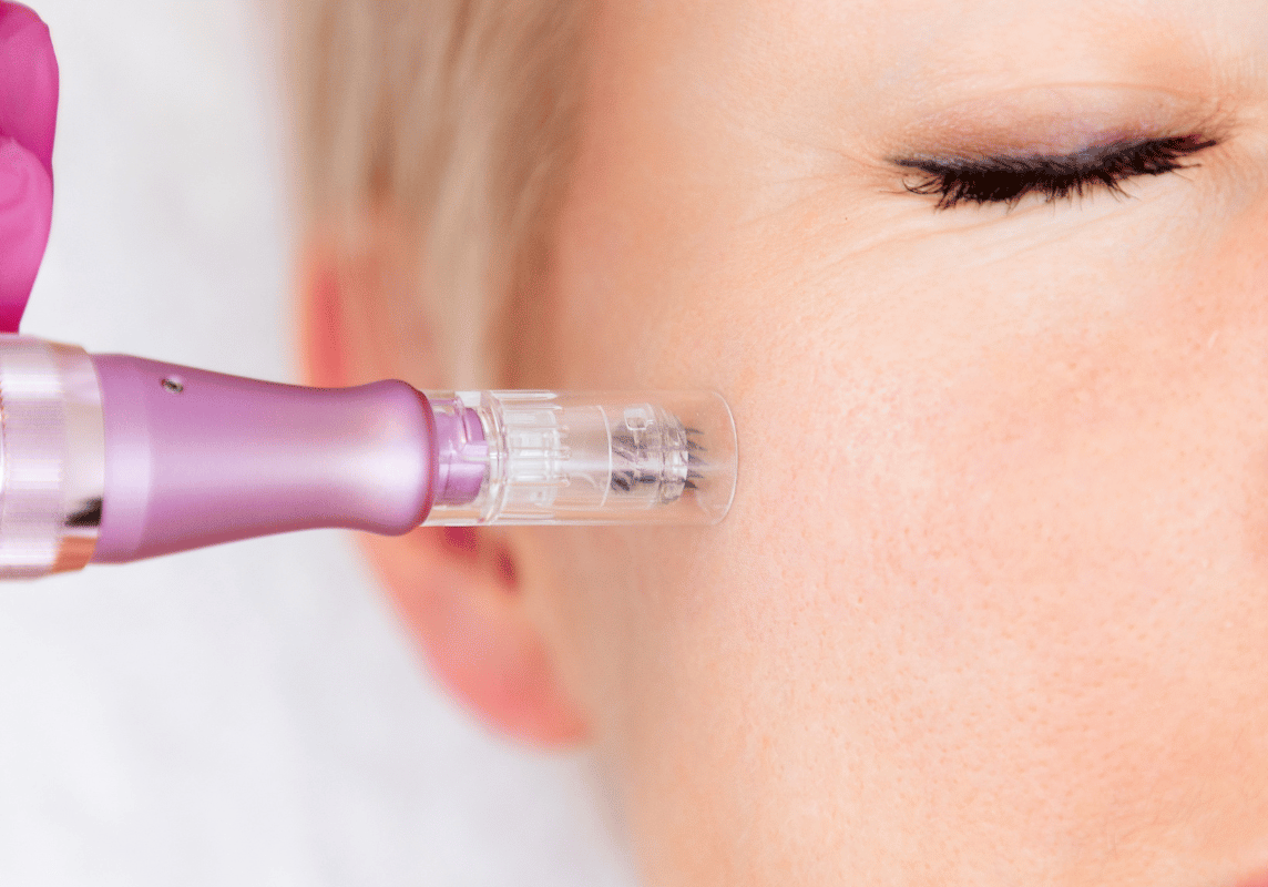 microneedling benefits
